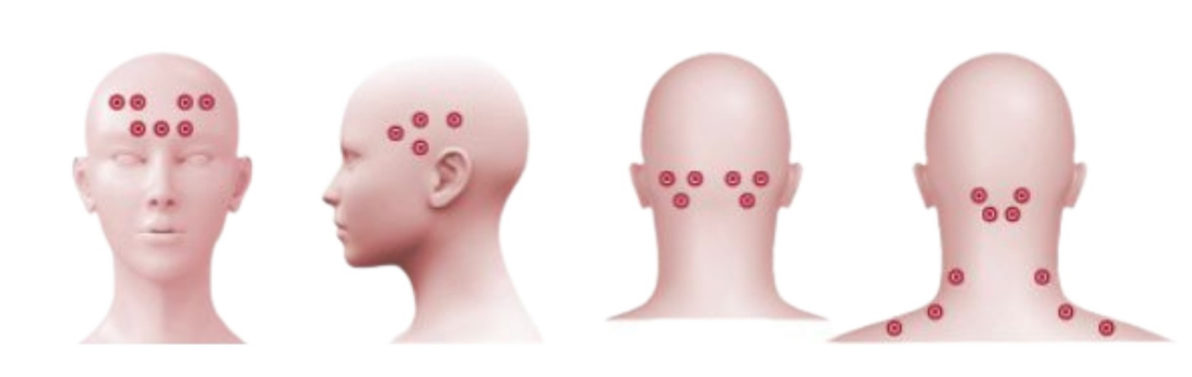 Ilustração dos pontos de aplicação de toxina botulínica na cabeça e pescoço