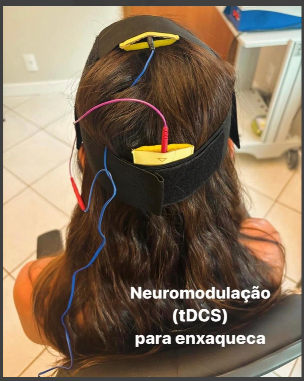 Aplicação de tDCS com eletrodos posicionados sobre o couro cabeludo de uma paciente para neuromodulação na enxaqueca.